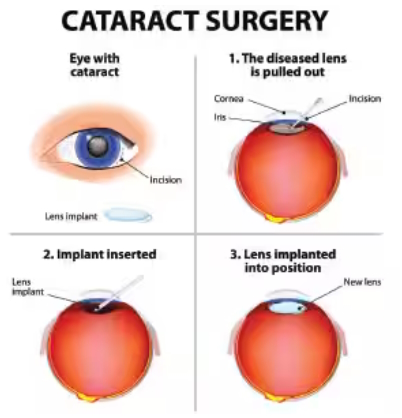 Cataracts, Glycation, and Carnosine
